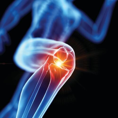 Photo showing inflammation in the knee of someone running. 